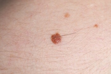 Woman with moles on her body, closeup