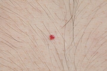 Man with mole on his body, closeup