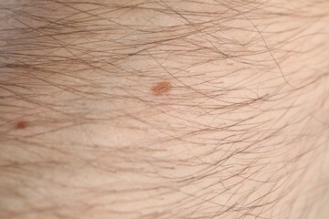 Man with moles on his body, closeup