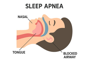 Fototapeta premium Vector illustration of sleep apnea, showing a labeled scheme of the nasal and tongue area blocking the airway