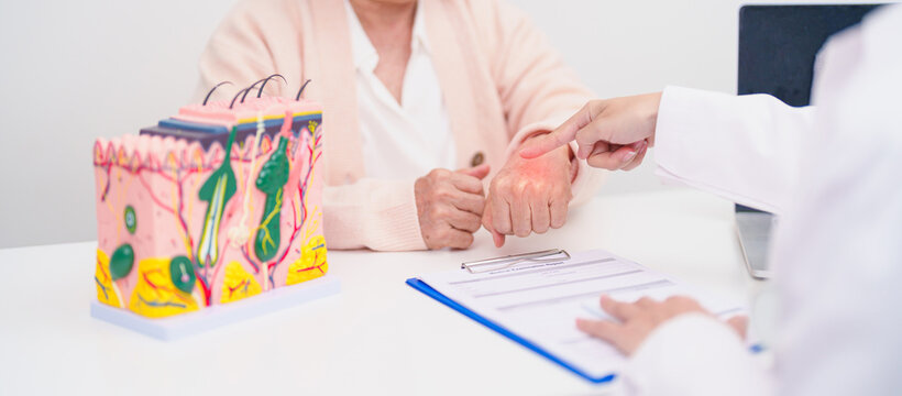 woman Patient consultation Dermatologist with anatomy of skin and hair. Skin disease and Hair loss, Systemic Lupus Erythematosus or SLE, world lupus day, May Melanoma and Skin Cancer Awareness month