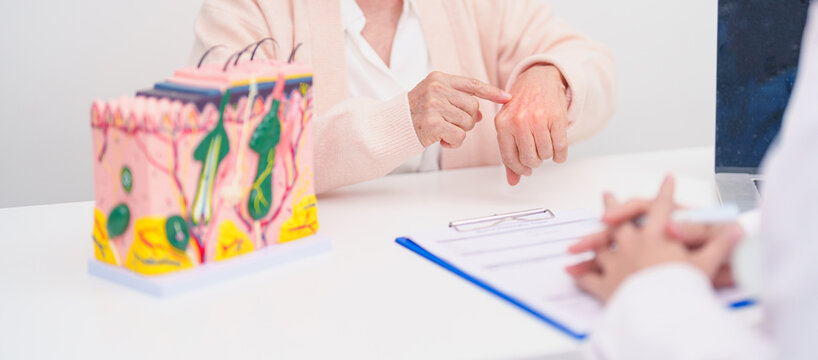 woman Patient consultation Dermatologist with anatomy of skin and hair. Skin disease and Hair loss, Systemic Lupus Erythematosus or SLE, world lupus day, May Melanoma and Skin Cancer Awareness month