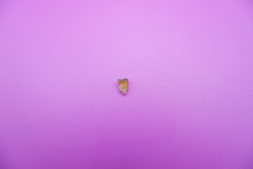 Extracted Tooth from Child with Dental Caries