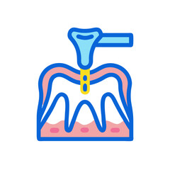 Illustration of dental implant placement with gingiva on White