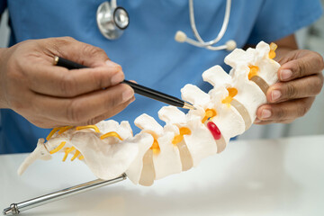 Asian doctor holding spinal nerve and bone model, Lumbar spine displaced herniated disc fragment...