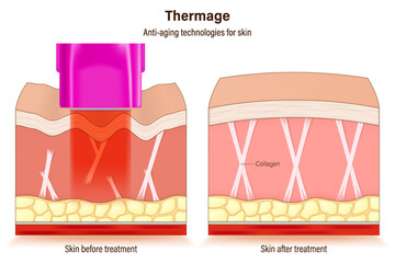 Thermage FLX treatment. Anti-aging technologies for skin. medical cosmetic procedures for skin. Compare skin condition before and after treatment.