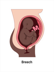 Breech baby positions in the uterus during pregnancy. Dark-skinned woman. Pathology. Detailed medical vector illustration. Fetus with umbilical cord, placenta.
