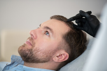 Obraz premium Doctor marking young man's forehead with hair loss problem