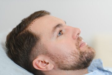 Obraz premium Closeup of female trichologist doctor marking hair line to male patient with hairloss problem. Concept of baldness treatment.