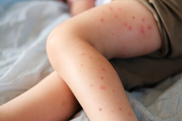 Child scratch body has sensitive itchy skin. Bodily rash. Kid allergy closeup. Little baby...