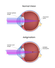 Comparison of Normal Vision and Astigmatism in the Human Eye