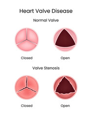 Heart Valve Disease Normal Valve vs Valve Stenosis