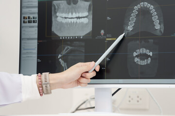 Close up hand of asian dentist pointing with pen at dental panoramic xray displayed on computer screen during diagnostic explanation in modern dental clinic environment