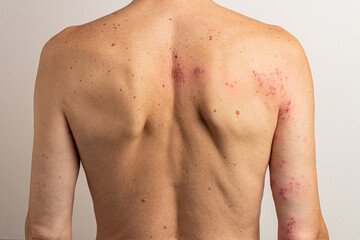 Patient exhibiting red blisters resulting from the reactivation of the varicella zoster virus, leading to shingles disease, characterized by a painful skin rash and discomfort