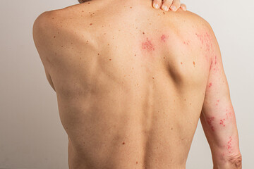 Caucasian man scratching his back, revealing red blisters and a rash caused by shingles, a viral infection linked to the herpes zoster virus, commonly associated with chickenpox