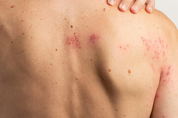 Herpes zoster infection causing a painful rash with blisters affecting the back and shoulder,...