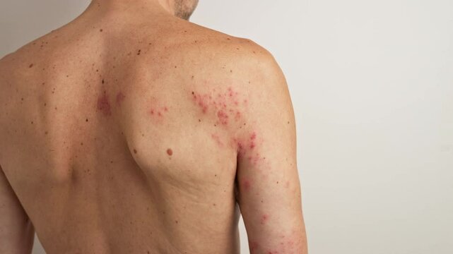 Multiple views of a man's back and arm affected by a painful herpes zoster virus rash, commonly known as shingles, highlighting the progression and severity of the skin condition