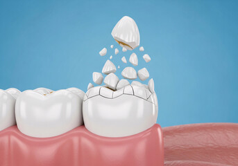 A Crumbling Tooth Representing Tooth Decay and Dental Health Problems