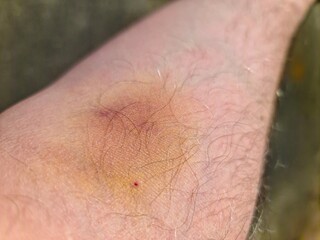 Large bruise forming on hairy arm after injection