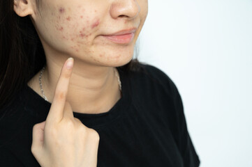 Cropped shot of Asian woman pointing to acne problems on her face. Inflamed acne consists of...