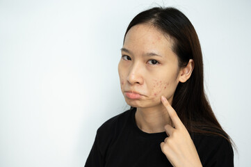 Serious Asian woman pointing to acne problems on her face.
