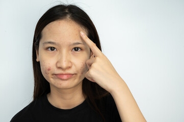 Portrait of young Asian woman pointing to acne problems on her face.