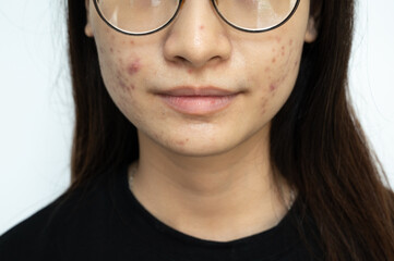 Cropped shot view of Asian woman having acne inflamed on her face.