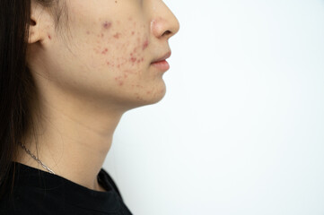 Side view of Asian woman having acne inflamed on her face. Inflamed acne consists of swelling,...