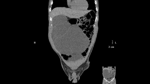 Coronal CT Scan of the Abdomen Showing Mass in the Distal Ileum
