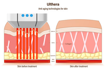 Ulthera treatment. Anti-aging technologies for skin. medical cosmetic procedures for skin. Compare skin condition before and after treatment.