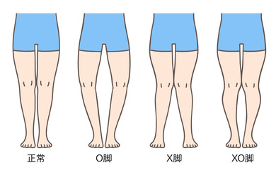 正常な脚、O脚、X脚、XO脚の姿勢とプロポーション