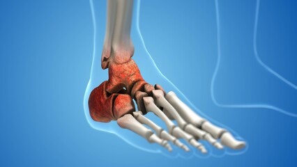 Osteoarthritic Degeneration in Ankle and Foot Joints