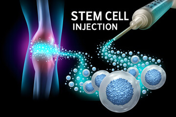 Stem Cell Injection in Knee Joint for Regenerative Medicine and Advanced Orthopedic Treatment