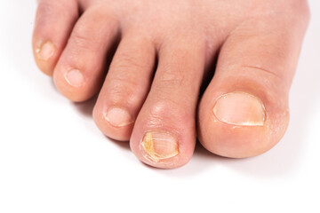 close-up of toenail infection ringworm in human, isolated on white background