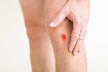 Young adult man hand touching leg with red abrasion bleeding knee skin after fell down. Isolated on...