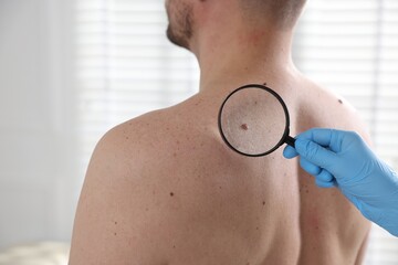 Doctor examining man's moles in hospital, closeup