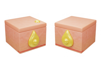 Illustration of skin with sebum production, showing the process of acne formation isolated on transparent background