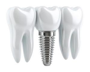 Dental implant procedure clinic educational medical. Isolated on transparent background, png.