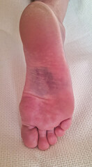 Bruised sole of foot with visible hematoma and skin discoloration. Close-up injury documentation....