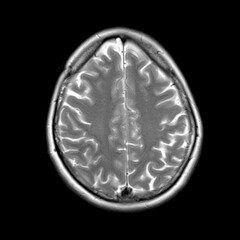 Axial T2-weighted MRI scan of a 40-year-old patient showing normal cerebral cortical anatomy with...