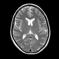 Axial T2-weighted brain MRI of a 40-year-old showing normal anatomy of lateral ventricles,...