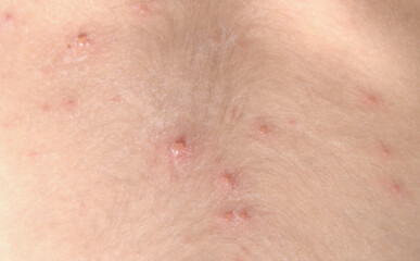 Fototapeta premium Human skin covered with red chickrnpox. High quality photo