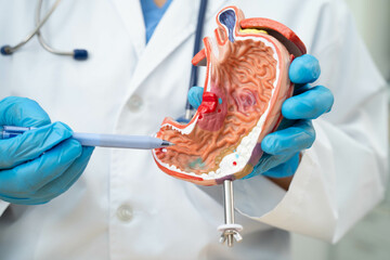 Stomach disease, doctor holding anatomy model for study diagnosis and treatment in hospital.