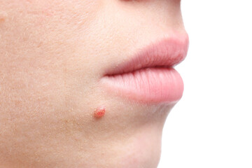 Woman with mole on her face against white background, closeup