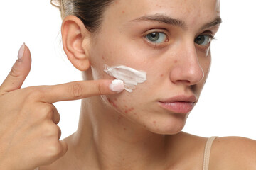 Serious young woman with acne applying cream to her face, studio shot on white background.