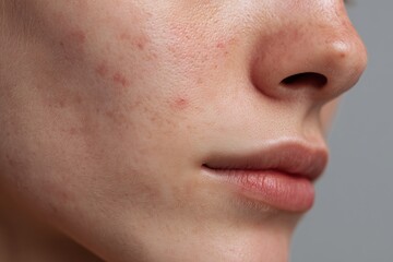 Close-up of a young person’s face with moderate acne and visible blemishes
