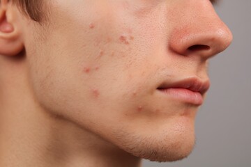 Close-up of a teenage boy&rsquo;s face with moderate acne, skin blemishes, and inflamed pimples on the cheek and chin