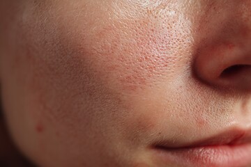 Fototapeta premium Close-up of facial skin with large pores and uneven texture, showing skin imperfections