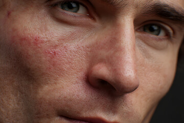 Fototapeta premium Before and after acne treatment on male face