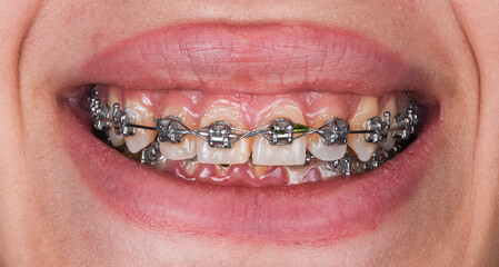 big lips and dental braces